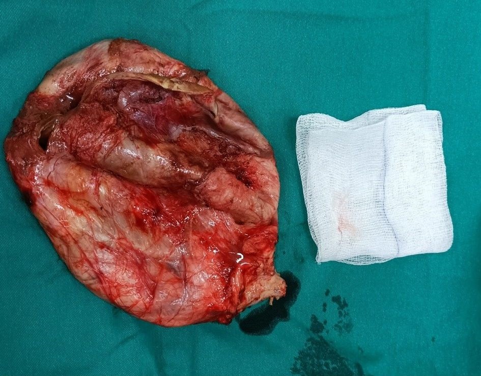 Khối u tinh hoàn khổng lồ được lấy ra thành công