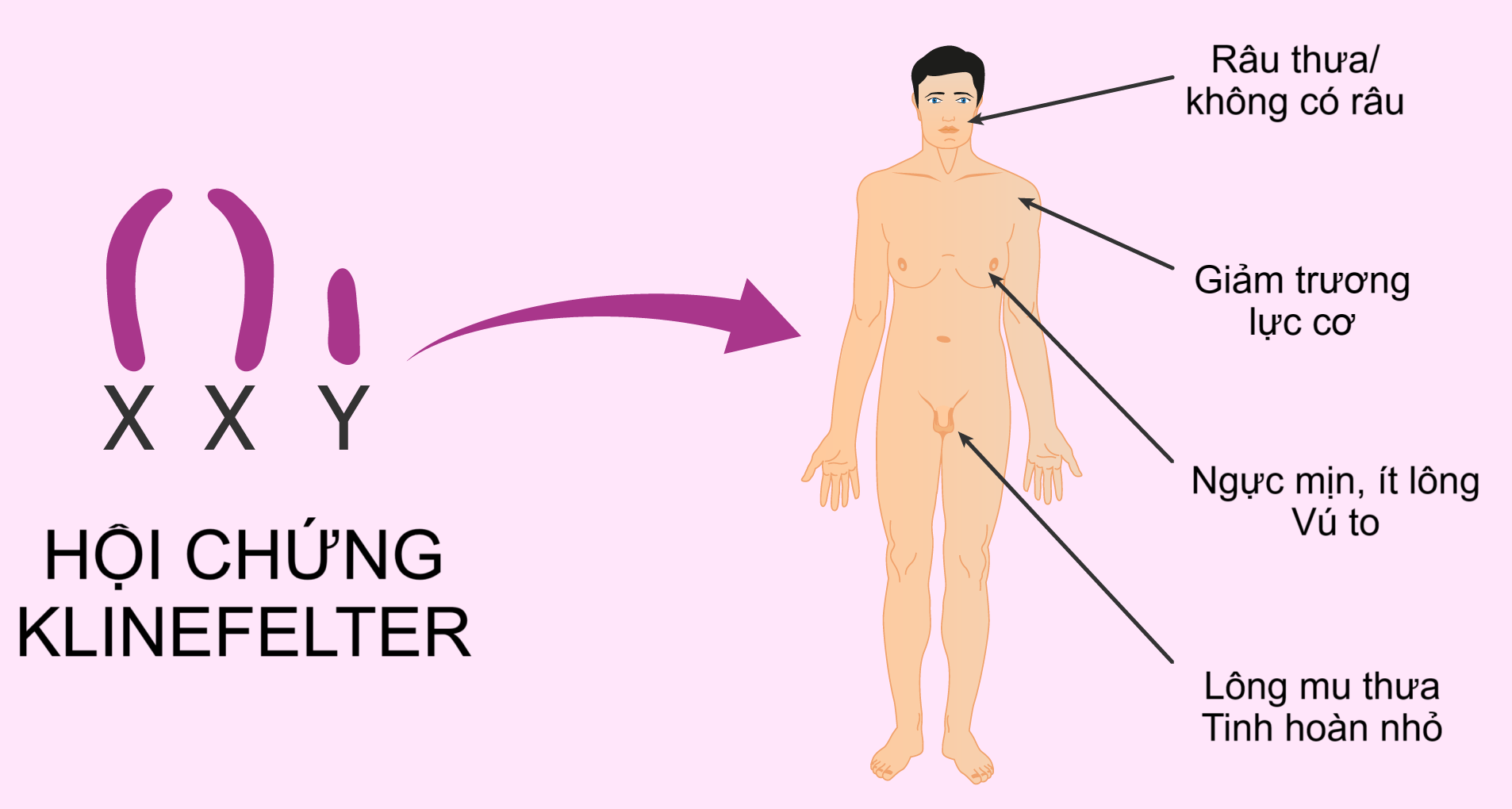 Hội chứng Klinefelter