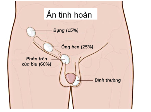 PHẪU THUẬT NỘI SOI CẮT TINH HOÀN ẨN, LẠC CHỖ