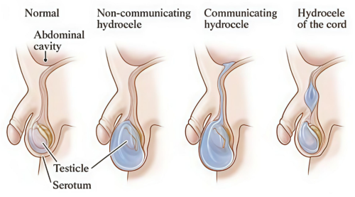 PHẪU THUẬT NỘI SOI THẮT ỐNG PHÚC TINH MẠC (NỘI SOI THẮT ỐNG NUCK)
