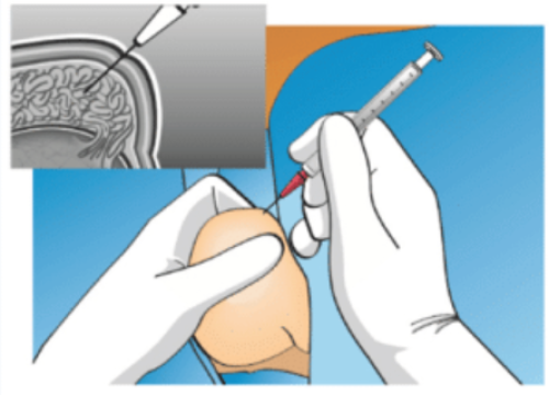 CHỌC HÚT TINH TRÙNG TỪ MÀO TINH HOÀN QUA DA (PESA)