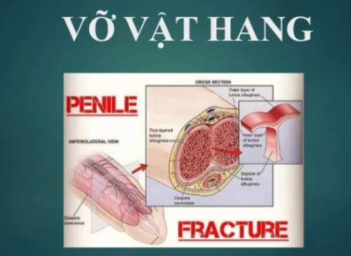 PHẪU THUẬT VỠ VẬT HANG DO GÃY DƯƠNG VẬT