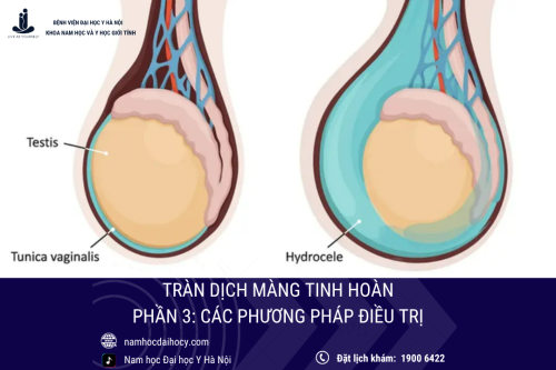 Tràn dịch màng tinh hoàn (phần 3): Các phương pháp điều trị