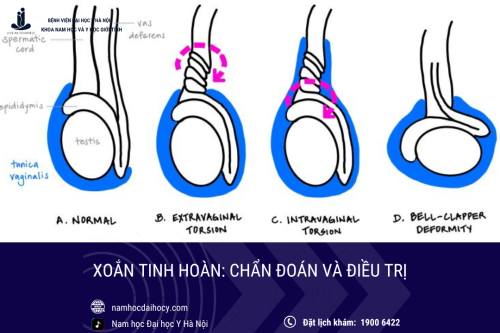 Xoắn tinh hoàn: Chẩn đoán và điều trị